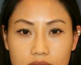 Lower eyelid bulges removal - after