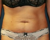Tummy Tuck San Diego 82 - before