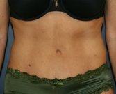 Tummy Tuck San Diego 82 - after