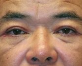 Blepharoplasty Case 25 - after