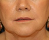 Corner of Lip Lift San Diego - after