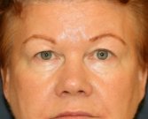 Upper Eyelid Skin Removal - before