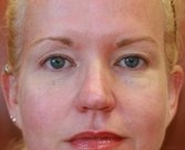 Blepharoplasty Case 26 - before