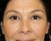 Lower eyelid tightening surgery - after