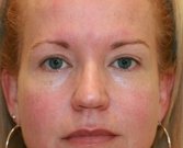 Blepharoplasty Case 26 - after