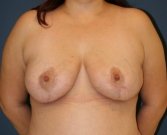 Breast Lift San Diego 29 - after