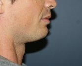 Chin Implant for Men - before
