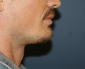 Chin Implant for Men - after