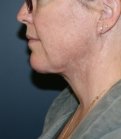 Necklift and Corner of Lip Lift - after