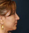 Rhinoplasty Case 11 - after