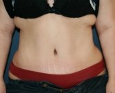 Tummy Tuck San Diego 84 - after