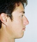 Rhinoplasty Case 12 - before