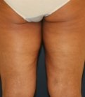 upper thigh-lift-san-diego - before