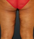 upper thigh-lift-san-diego - after