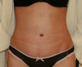 Tummy tuck San Diego 85 - after