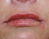 Filler (Glucuronic Acid) in Upper and Lower Lips - after