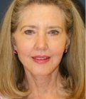 Laser Facial Skin Treatment - after