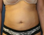 Tummy Tuck San Diego 86 - before