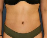 Tummy Tuck San Diego 86 - after