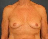 Breast Implants - before