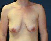 Breast Lift Surgery San Diego 31 - before