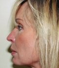 Rhinoplasty Case 15 - before