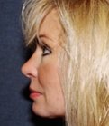 Rhinoplasty Case 15 - after