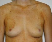 Breast Augmentation Case 7 - before