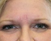 Filler (hyaluronan) into squint lines - after