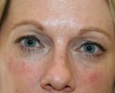Filler beneath lower eyelids - after