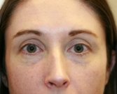 Filler for darkness of lower eyelids - before