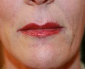 Lip Creases Lip Lines and Slight Lip Augmentation - after