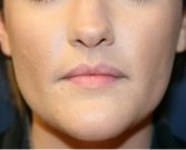 Belotero Lip Augmentation - before