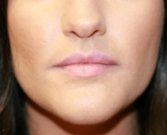 Belotero Lip Augmentation - after