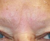 Gel Filler (Restylane Fine Line) into brow creases - before