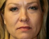 Filler Lower Eyelids and Corners of Lips - after