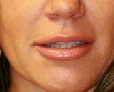 Juvederm Ultra Plus 1 ml lip augmentation - before