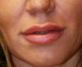Juvederm Ultra Plus 1 ml lip augmentation - after