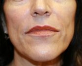 Lip Lines Filler - after
