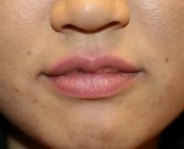 Fuller Lips by Juvederm Ultra Plus - before