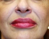 Filler in creases around lips - before