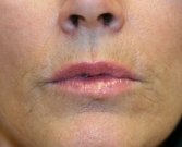 Lip Lines (fine creases around lips) - before