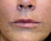 Lip Lines (fine creases around lips) - after