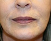 Lip Lines and wrinkles around lips - before
