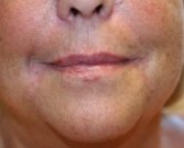 Smile Lines Treatment (filler) - after