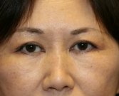 cheek lines-cheek dents - before