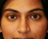 Lower eyelid darkness - before