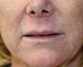 Smile Lines (Nasal-Labial Folds) Filler - before