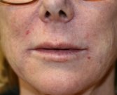 Smile Lines (Nasal-Labial Folds) Filler - after