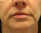 Filler Gel for Smile Lines Around Lips - before